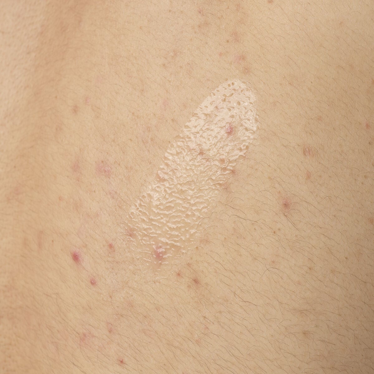 salicylic-acid-0-5-body-serum-e2 ORD-salicylic-acid-05-body-240ml-application.jpg
