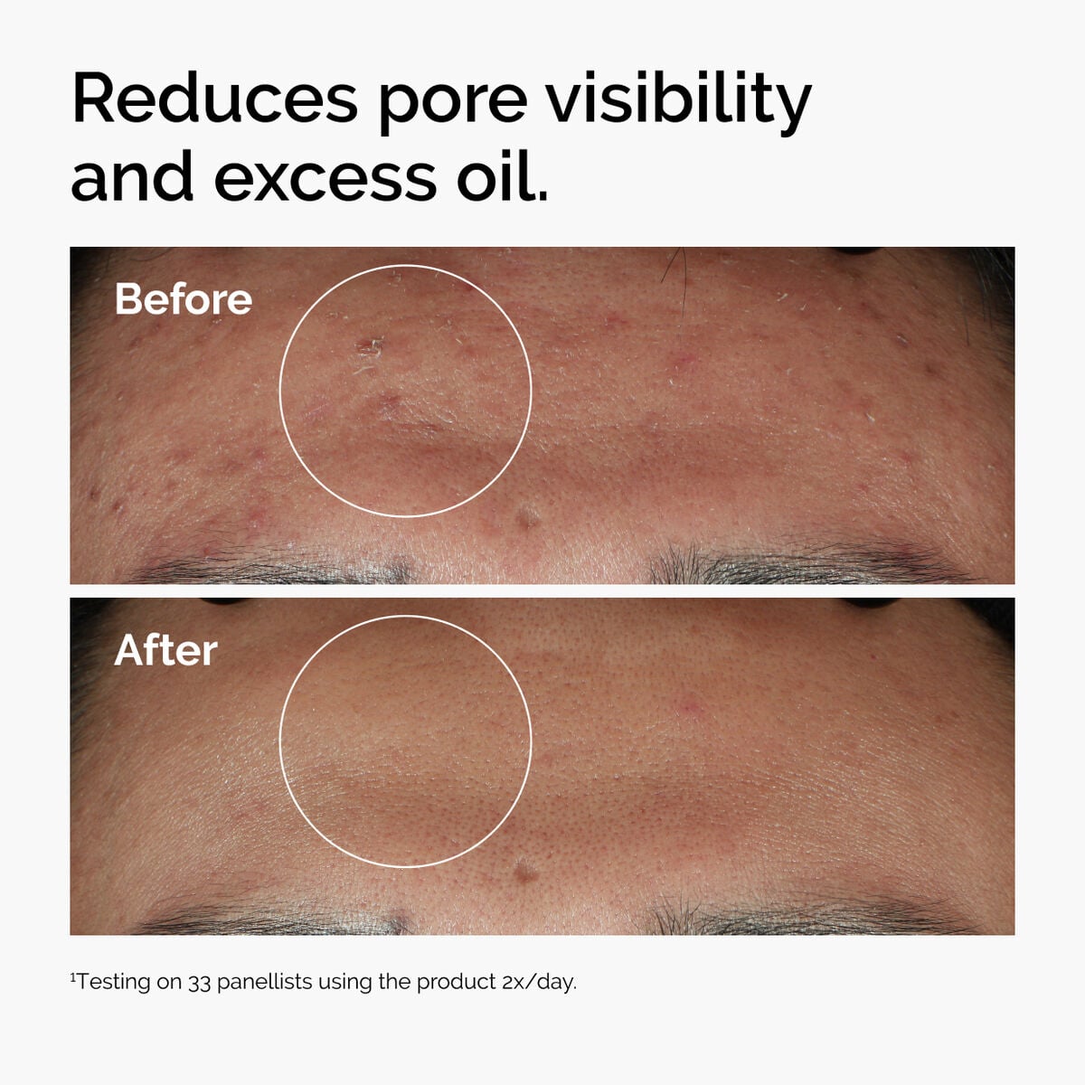 niacinamide-10-zinc-1-i7 ord-niacinamide-zinc-blemish-serum-before-after-pores.jpg