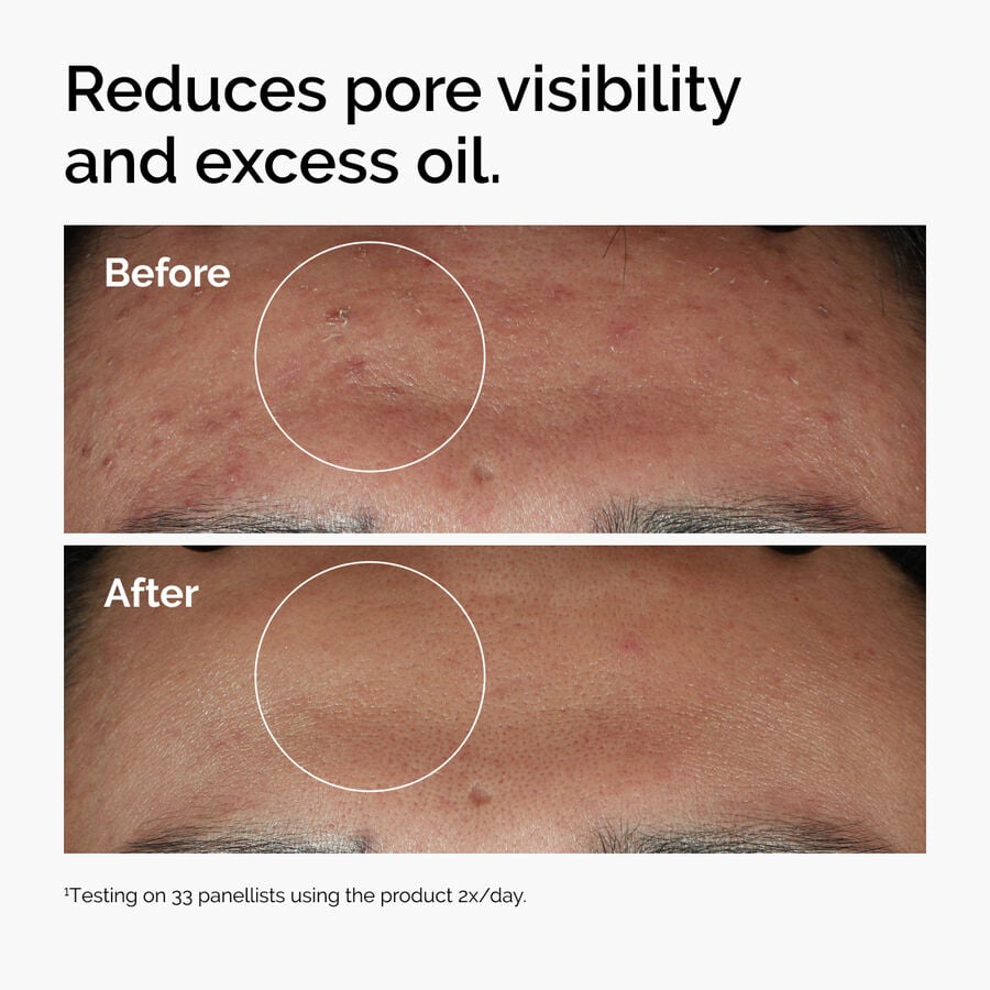 niacinamide-10-zinc-1-i7 ord-niacinamide-zinc-blemish-serum-before-after-pores.jpg