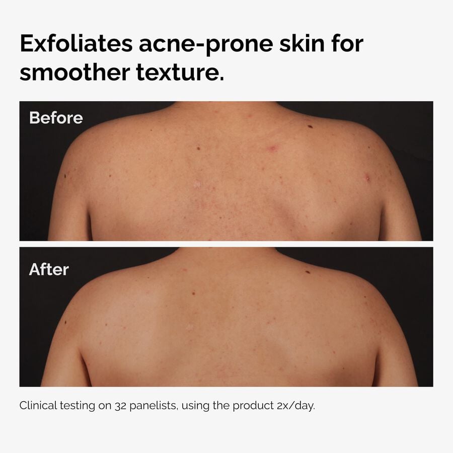 the-body-care-collection-j8 ord-salicylic-acid-body-serum-before-after-graphic-NA.jpg